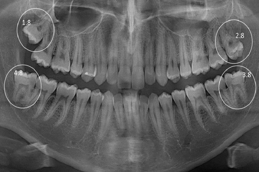 Denti del giudizio4