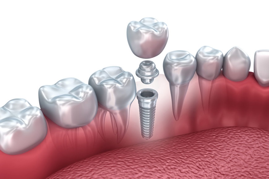 Impianti dentali3