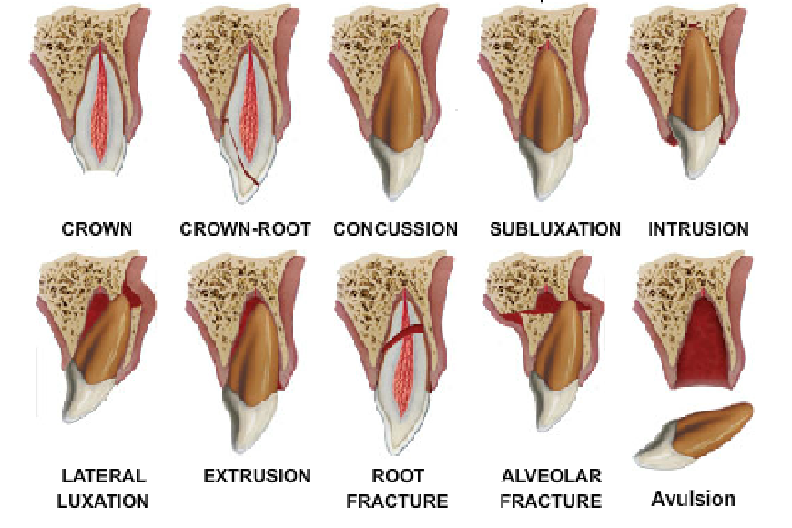 Traumi dentali4