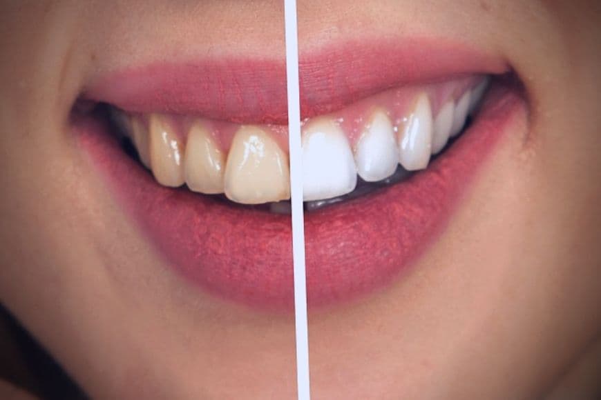 Il colore naturale dei denti, le macchie e lo sbiancamento