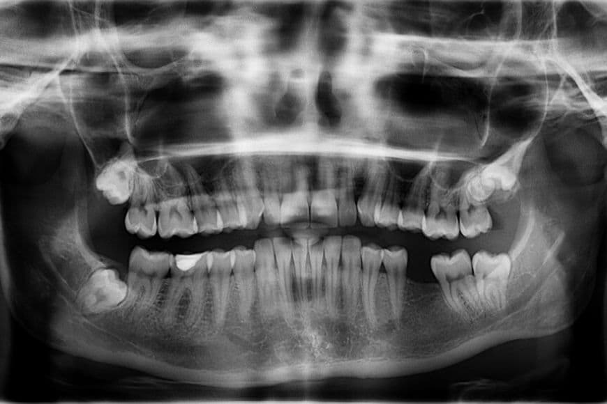 radiografie denti 02