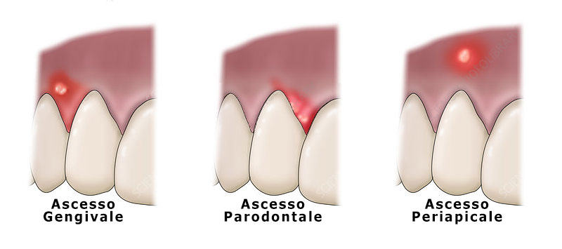 tipi accessi dentali