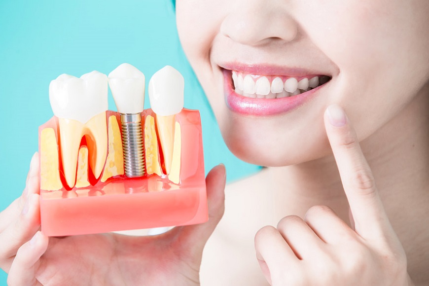 IMPIANTI DENTALI, PRECAUZIONI E PATOLOGIE CORRELATE