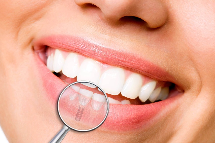 Impianti zigomatici e all on 4 per atrofia mascellare e ossea