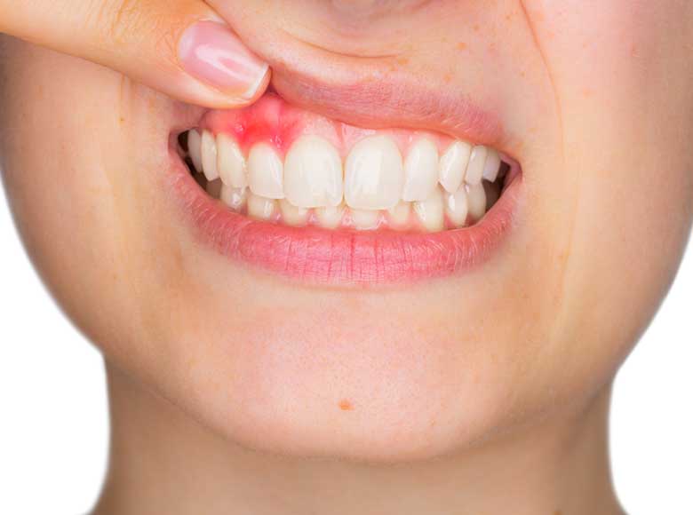 cos'è e come si cura un ascesso dentale